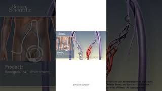 Nonsurgical treatment of Varicocele 3D animation  Varicocele embolization  by Dr Gaurav G [upl. by Vladamar353]