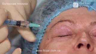 Правильная техника введения Dermaheal Eyebag Solution  FloSal [upl. by Garv]