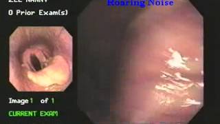 roaring disease laryngeal hemiplegiaby endoscopy [upl. by Marchelle924]