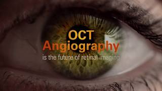 OCT Angiography OCTA by Optovue [upl. by Zevahc447]