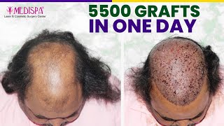 5500 Grafts Hair Transplant in Grade 6 Baldness in single sitting drsuneetsoni1 [upl. by Solon]