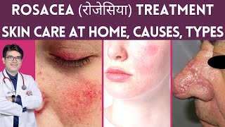 Rosacea Treatment Skin Care Laser Treatment  Rosacea का इलाज  Rosacea Causes Types  Hindi [upl. by Yesnikcm534]