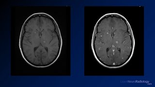 Neuroradiology board review 3 case 5 [upl. by Asiluj19]