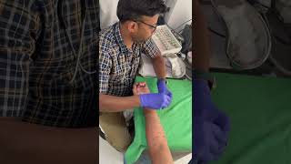 Skin Prick Test allergytest immunotherapy doctor health viral trending amazing healthcheckup [upl. by Durer]