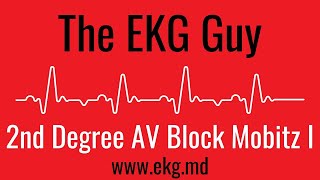 Second Degree AV Block Mobitz 1 Wenckebach EKG l The EKG Guy  wwwekgmd [upl. by Atinreb]