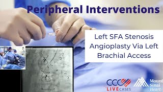 Left SFA Stenosis Angioplasty Via Left Brachial Access – Peripheral Live September 2017 [upl. by Haroppiz]