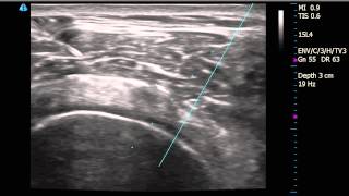 Right Shoulder Subacromial Bursitis diagnosed by Ultrasound with injection [upl. by Karola184]