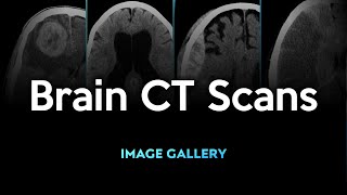 Brain CT Scans Image Gallery [upl. by Aiehtela]