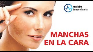 CAUSAS y TRATAMIENTO del las MANCHAS CAFÉ en la CARA 🙈🙉🙊 MELASMA MALAR 🤦‍♀️ ETERNA JUVENTUD [upl. by Lledualc]