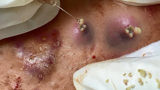 Big Cystic Acne Blackheads Extraction Blackheads amp Milia Whiteheads Removal Pimple Popping [upl. by Joey]