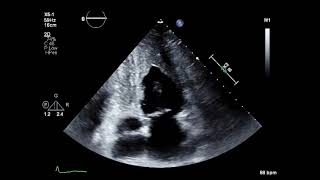 Endomyocardial Fibroelastosis [upl. by Bloch]