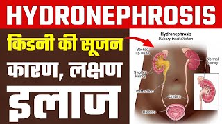 Hydronephrosis हाइड्रोनफ्रोसिस या क‍िडनी में सूजन के कारण लक्षण और इलाज  hydronephrosis treatment [upl. by Sueaddaht536]