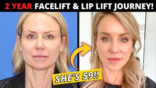 59 Year Olds 2 Year Facelift and Lip Lift Journey her entire postop recovery [upl. by Cinderella]