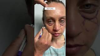 Under Eye Fat Pad Herniation Correction with Dr Kami Parsa  Trifecta Lift [upl. by Turino340]