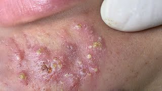 Big Cystic Acne Blackheads Extraction Blackheads amp Milia Whiteheads Removal Pimple Popping  324 [upl. by Deraj]