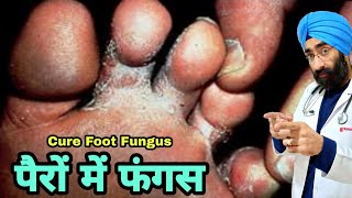 Fungal Feet Infection ka pakka elaaj  Athletes Foot Cure  Tenia Pedis  DrEducation Hindi [upl. by Barker]