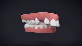 Invisalign® Treatment with Manidublar Advancement [upl. by Nevla]