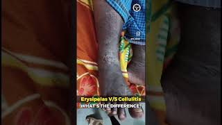 Erysipelas vs Cellulitis [upl. by Boyden]