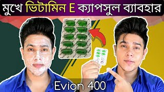 Evion 400 এর সাহায্যে মুখ ফর্সা এবং ব্রণ কমানোর 100  কার্যকরী সহজ উপায়  ভিটামিন ই ক্যাপসুল [upl. by Joice]