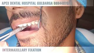 Subcondylar Fracture reduction by IMF at APEX DENTAL GULBARGA 8884407070 [upl. by Aizatsana]