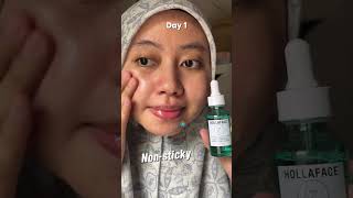 The Ultimate HOLLAFACE Anti Acne Serum That Quickly Reduces Breakouts malaysiaskincare [upl. by Yra]