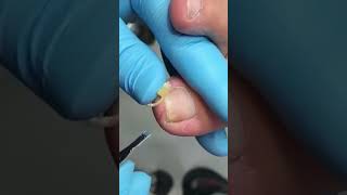 Ingrown toenail removal with Pedicure Knife Cut it easily Ep524 [upl. by Reiter]