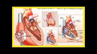 Herzrhythmusstörungen Neue heilende Therapie gegen Vorhofflimmern [upl. by Coppola]