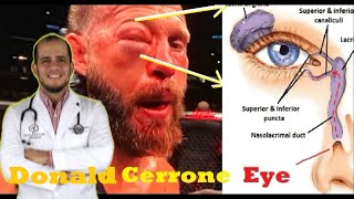 Cowboy Cerrone Swollen Eye explanation [upl. by Eiggep723]