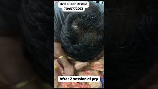 Case Study  PRP Treatment Results after 2 Months  PRP for Hair  Hair Transplant in Mumbai [upl. by Aket]