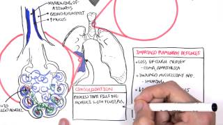 PART I  Pneumonia Overview Lobar and Bronchopneumonia [upl. by Mcquoid]