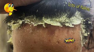 Combing Lots of Flakes  Itchy Scalp Treatment  Seborrheic dermatitis 918 [upl. by Naelopan]