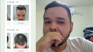 🔴 Minoxidil Oral Manual  Fotos Antes e Depois  1 Mês e Meio de Tratamento [upl. by Earvin]