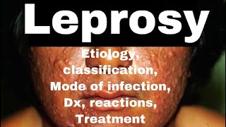 Leprosy Hansens Disease Hansaniasis  etiology classificationdiagnoserxnsMx  MisMedicine [upl. by Ettenyl]