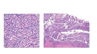 Adult granulosa cell tumor [upl. by Ecnerrat]