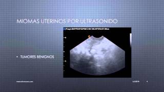 MIOMAS UTERINOS VISUALIZADOS POR ULTRASONIDO [upl. by Jenny]