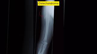 Osteochondroma radiological [upl. by Mikkanen]