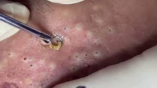 blackheads New this week 2023 [upl. by Weston90]