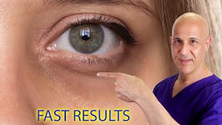 Remove Eye Bags Dark Circles Acne and Get Clear Skin Naturally Dr Mandell [upl. by Kabab150]