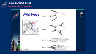 Embolization of AV Malformations Tips and Tricks [upl. by Oirad204]