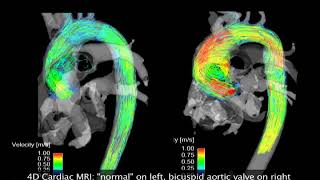 4DMRI  Bicuspid Aortic Valve [upl. by Brander96]