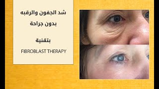 شد الجفون والرقبه بدون جراحه  FIBROBLAST THERAPY [upl. by Oicnoel]