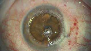 DALK bigbubble technique Deep anterior lamellar keratoplasty [upl. by Gnurt56]