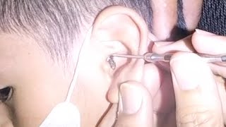 HUGE HARD Earwax Stuck in Boys Ear Removed [upl. by Haya]