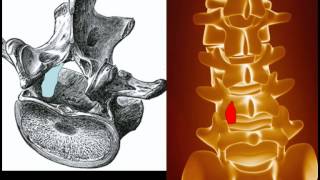 Behandlung der Spinalkanalstenose [upl. by Annawaj]