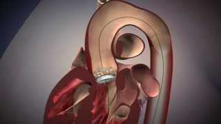 TAVR Edwards Sapien Aortic Valve Deployment [upl. by Eelarac]