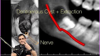 Taking you Through Removal of an Impacted Wisdom Tooth and Dentigerous Cyst [upl. by Ujawernalo201]