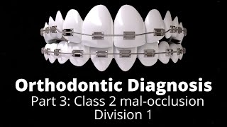 orthodontics Treatment planning Part 3 Class 2 div 1 malocclusion Orthodontic Courses Lecture [upl. by Neeleuqcaj]