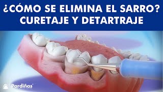 ¿Cómo se ELIMINA EL SARRO  Curetaje y limpieza dental © [upl. by Brod]