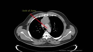 CT Thorax  How to Read [upl. by Eerak493]