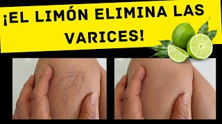 ¡El limón elimina las varices Solo haz esto todos los días [upl. by Darryl633]